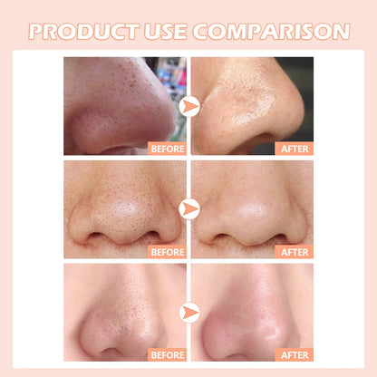 Blackhead Remover Facial Blemish Extractor